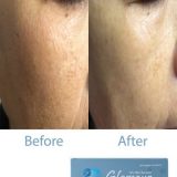 Skinboosters Injection before after pictures