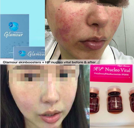 Glamour skin boosters treatment review